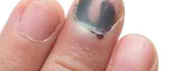 Меланома ногтя: признаки и лечение