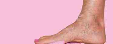 Как можно определить симптомы тромба в ноге