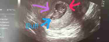 6 неделя беременности: описание, размер плода, ощущения