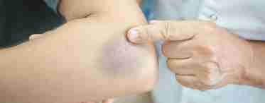 Постинъекционные осложнения: гематома, инфильтрат, абсцесс после укола