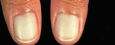 Изменились ногти: неправильный уход или сигнал о болезни?