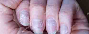 Псориаз ногтей: болезнь и фактор риска