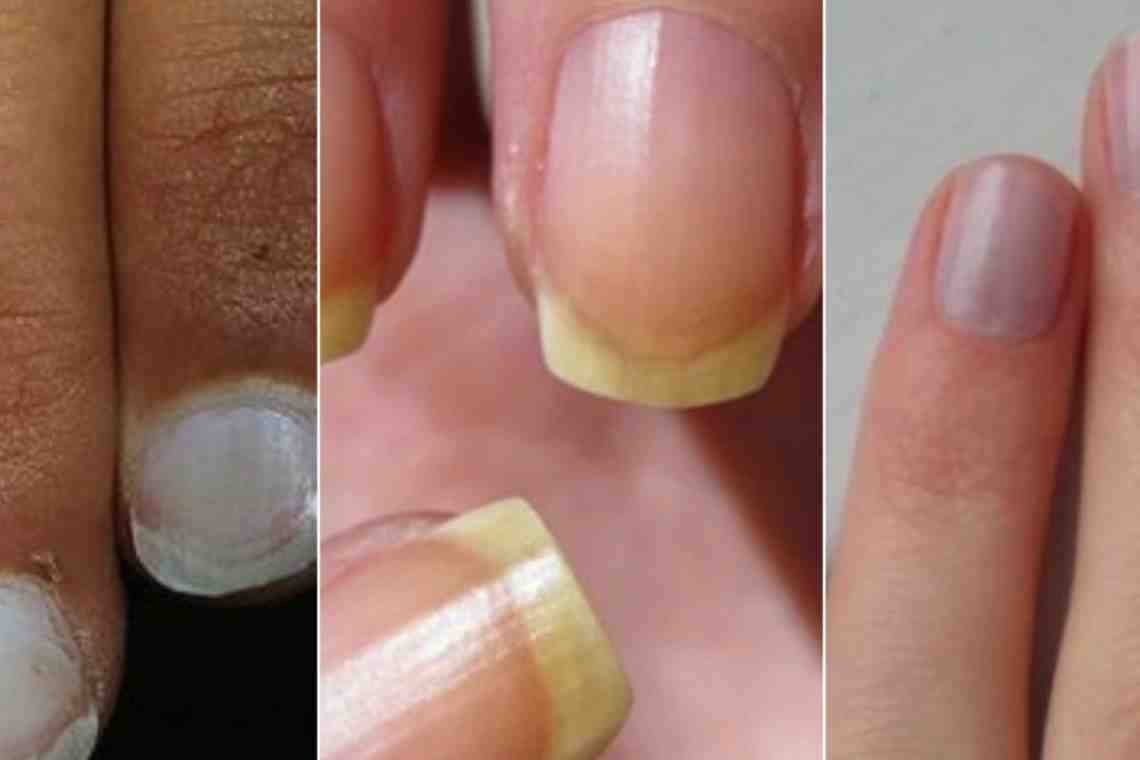 Тайны лунки на ногтях: как заметить анемию и цирроз