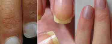 Тайны лунки на ногтях: как заметить анемию и цирроз