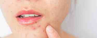 Причины угревой сыпи на коже у женщин после 30 лет