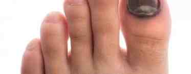 Кандидоз ногтей на ногах: причины и профилактика