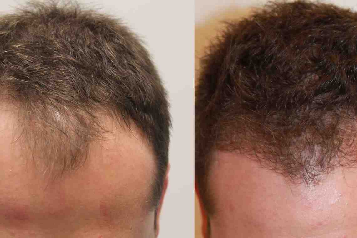 Пересадка волос на голове: суть процедуры, достоинства и недостатки