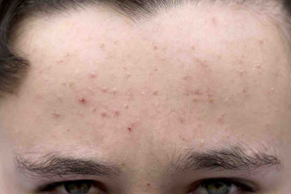 Красота под угрозой: как убрать высыпания на коже лица?