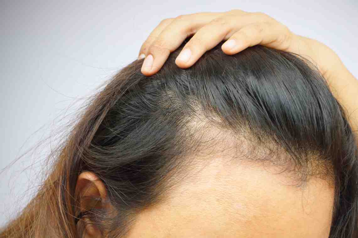 Выпадение волос, причины и способы лечения