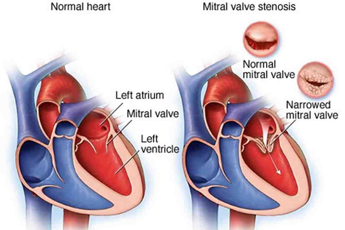 Кардиология. Клапаны сердца - жизнь человека