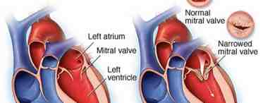 Кардиология. Клапаны сердца - жизнь человека