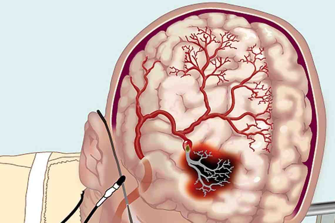 Средняя мозговая артерия: строение, возможные патологии, диагностика и лечение