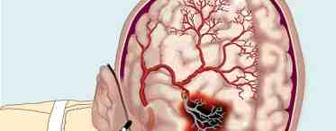 Средняя мозговая артерия: строение, возможные патологии, диагностика и лечение