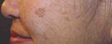 Себорейный кератоз кожи: лечение, прогноз, симптомы и возможные причины