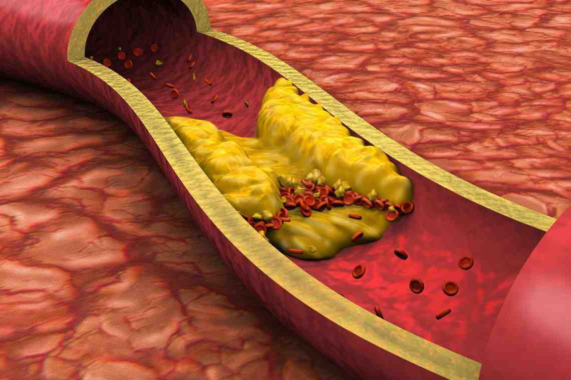 Атеросклероз: симптомы и лечение