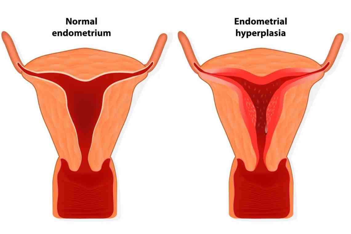 Гиперплазия эндометрия матки