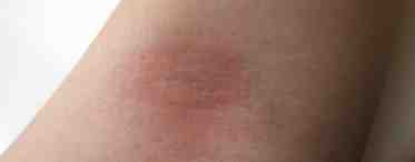 Шелушащиеся пятна на коже: причины и методы лечения