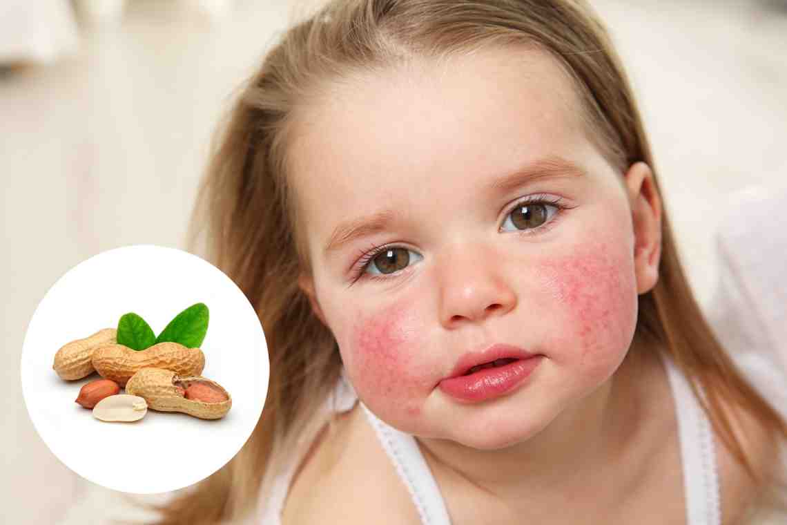 Сыпь у ребенка: виды, причины возникновения и лечение