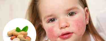 Сыпь у ребенка: виды, причины возникновения и лечение