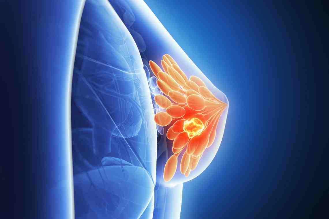 Рак груди у мужчины: причины, симптомы, профилактика, диагностика и лечение