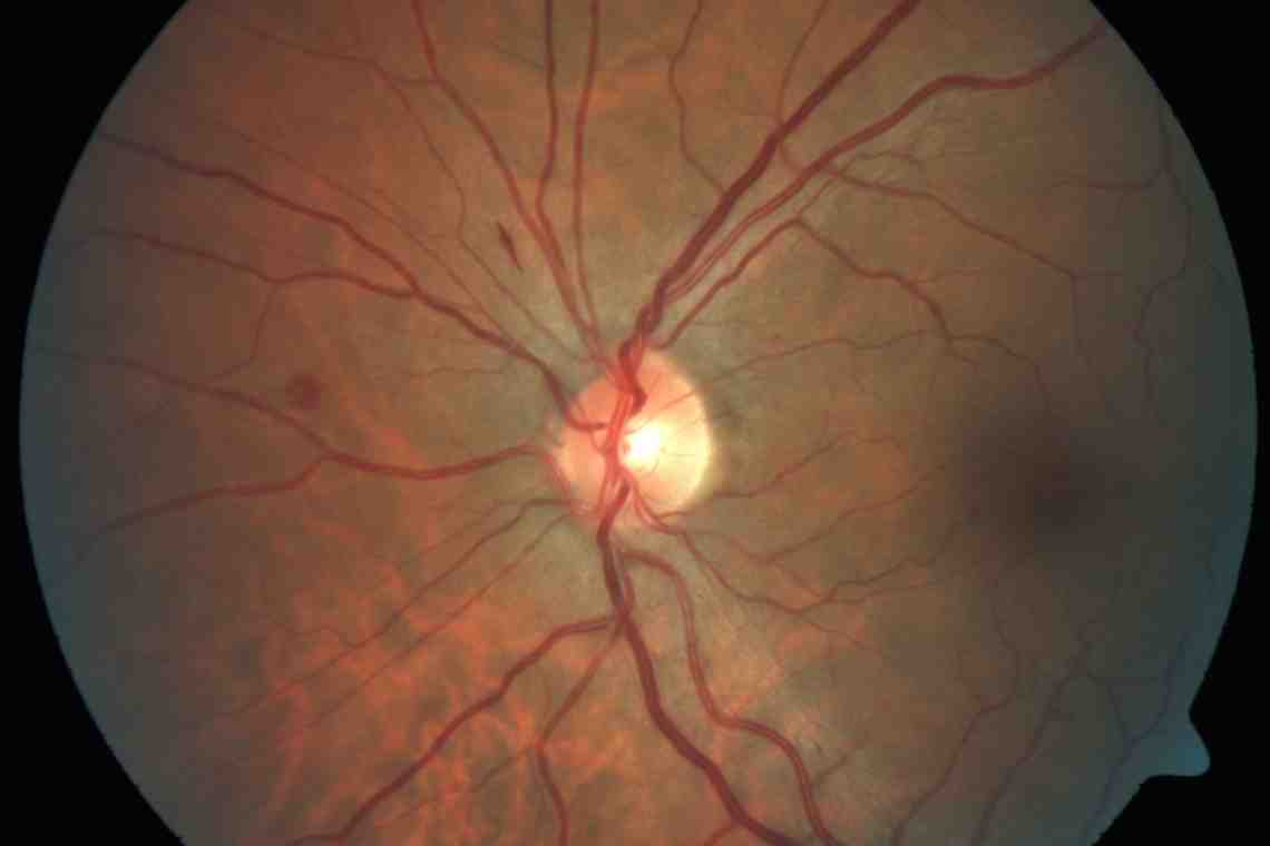 Застойный диск зрительного нерва: причины, симптомы и особенности лечения