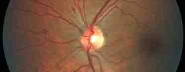 Застойный диск зрительного нерва: причины, симптомы и особенности лечения