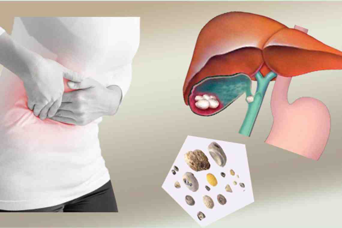 Приступ холецистита - симптомы, лечение в домашних условиях: что делать, как снять боль?