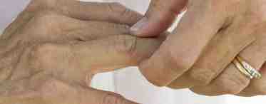 Болит мизинец на правой руке: возможные причины и лечение