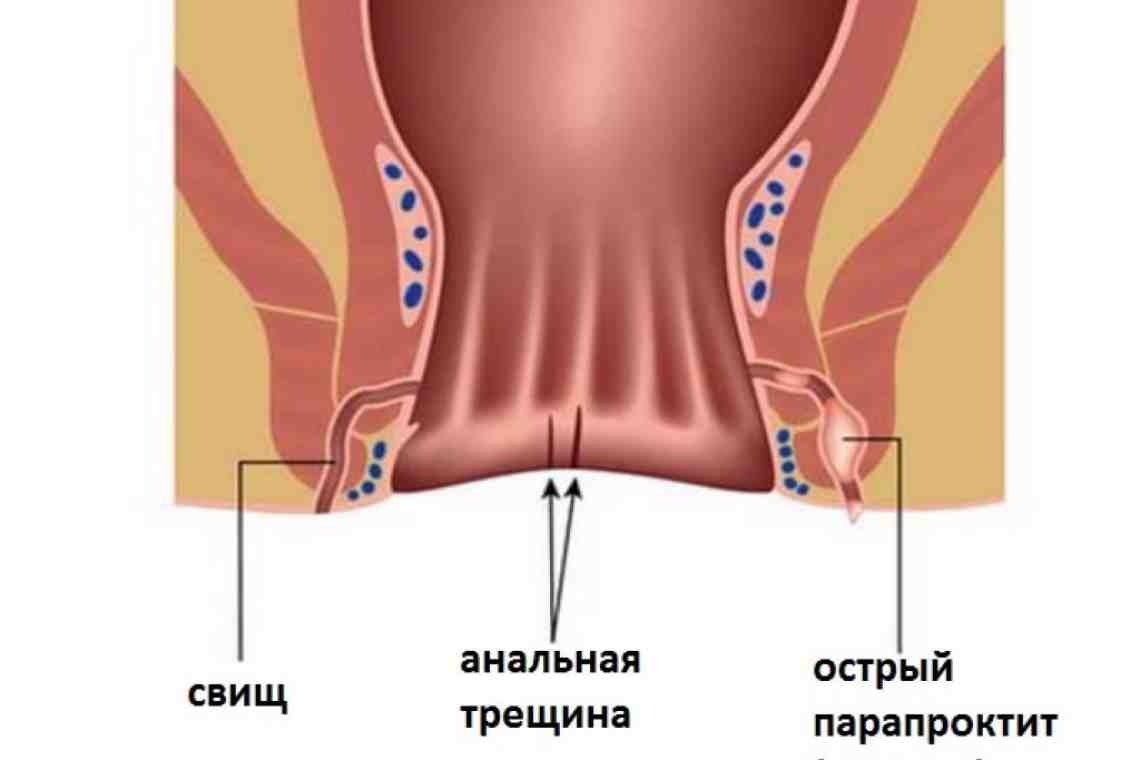 Ректальная операция