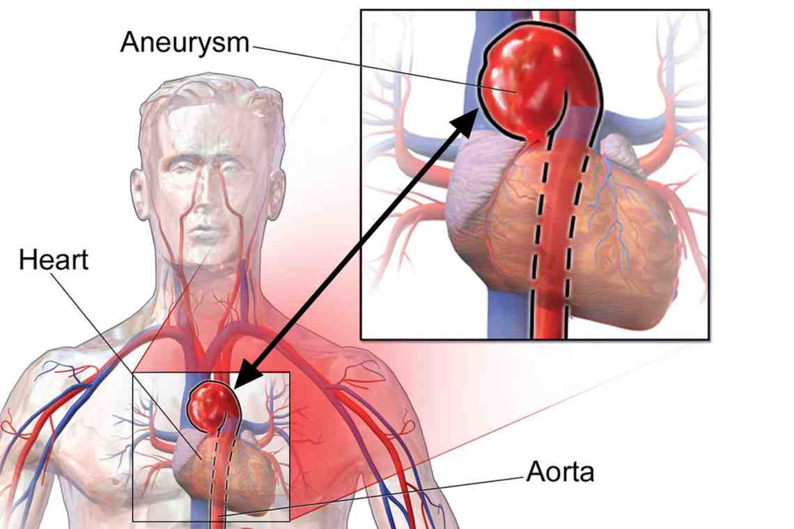 Аневризма Сердца – причины, симптомы, диагностика и лечение