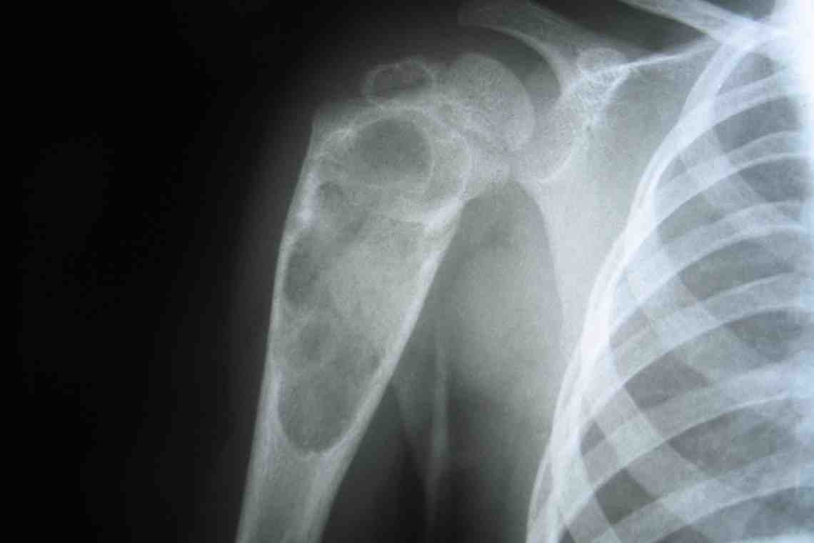 Саркома кости: причины заболевания, способы лечения