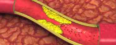 Холестериновые бляшки в сосудах: причины, лечение и последствия