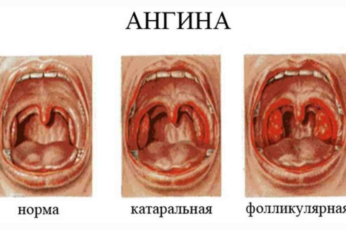 Острый тонзиллит: симптомы и лечение заболевания