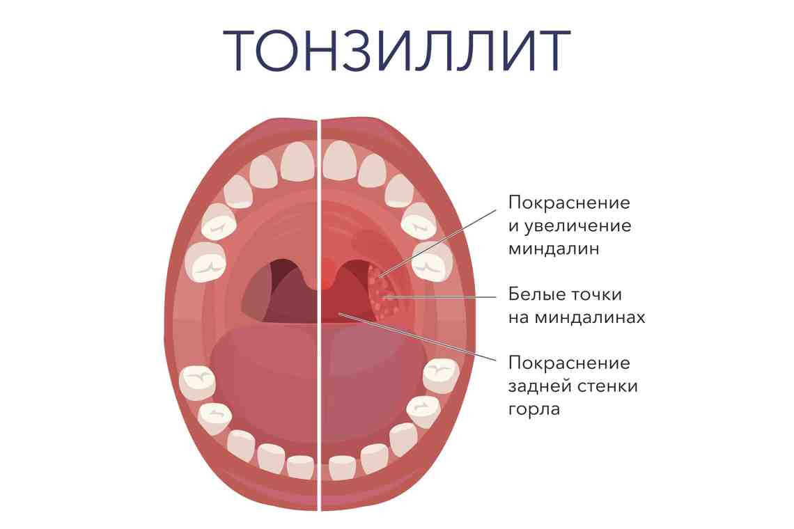 Симптомы и признаки фарингита у взрослых и детей