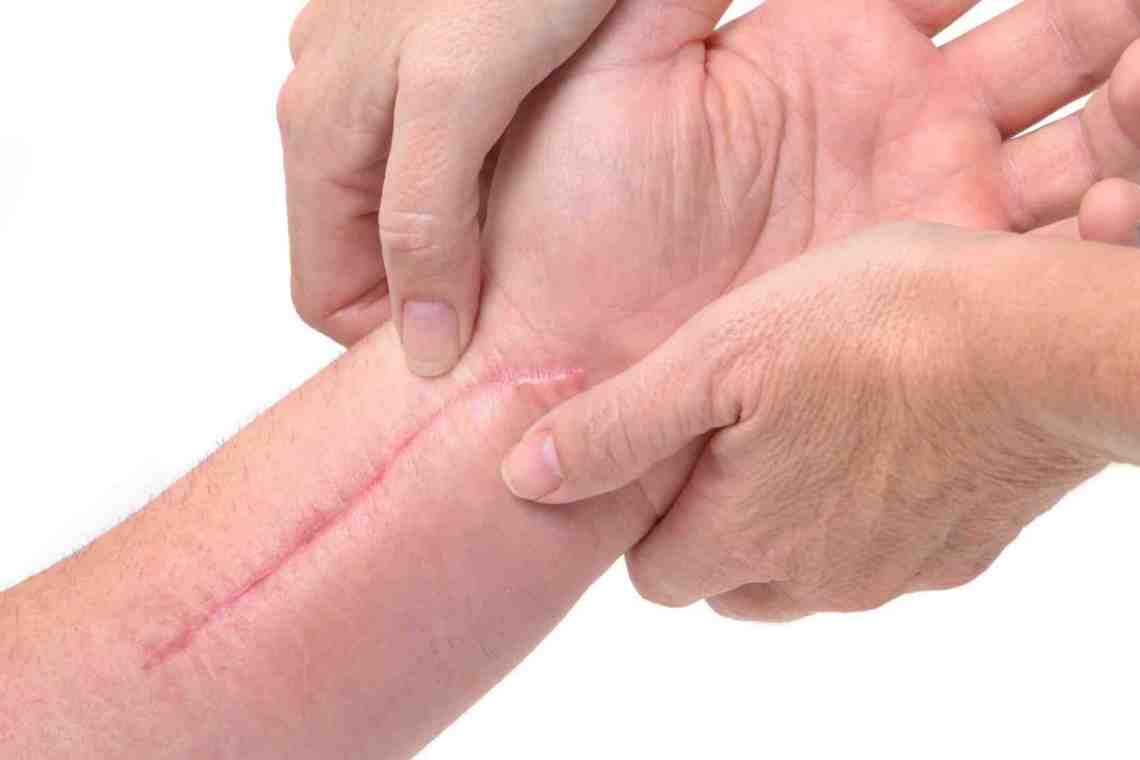 Незаживающая рана: как и чем лечить?