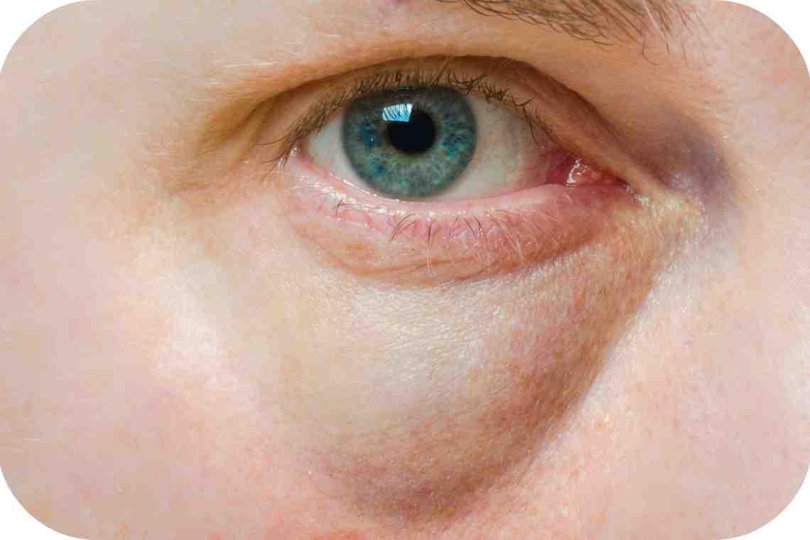 Отекли глаза: причины и лечение