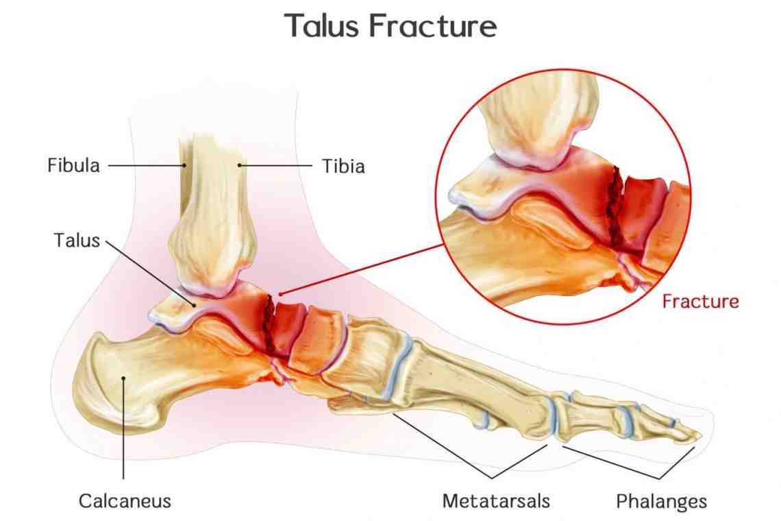 Таранная кость стопы: анатомия и травмы