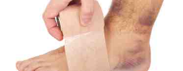 Растяжение связок голеностопа: лечение и последствия