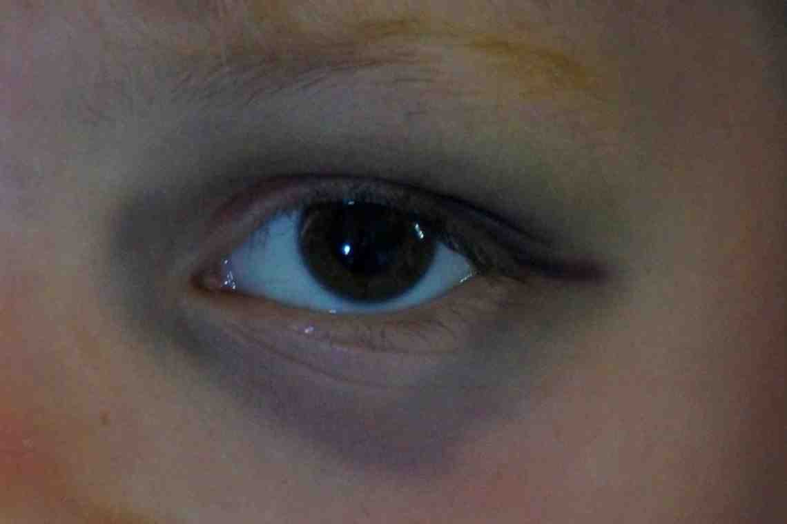 От чего у ребенка синяки под глазами: возможные заболевания, диагностика и лечение