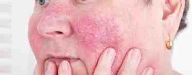 Воспаление кожи на лице: причины, виды, профилактика и особенности лечения
