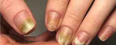 Псориаз ногтей: причины, симптомы и методы лечения