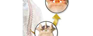 Стеноз спинномозгового канала: причины, симптомы, лечение