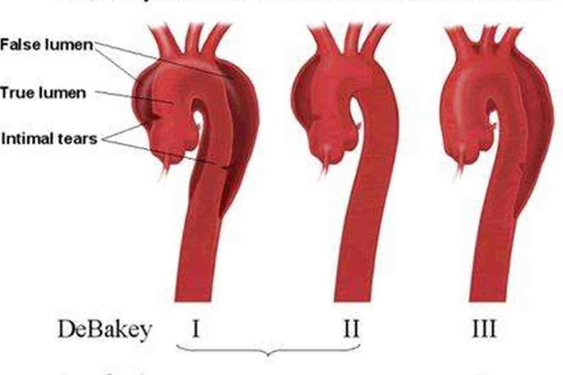 Расслоение аорты фото