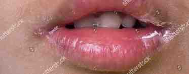 Пузырьки на губах: причины и лечение