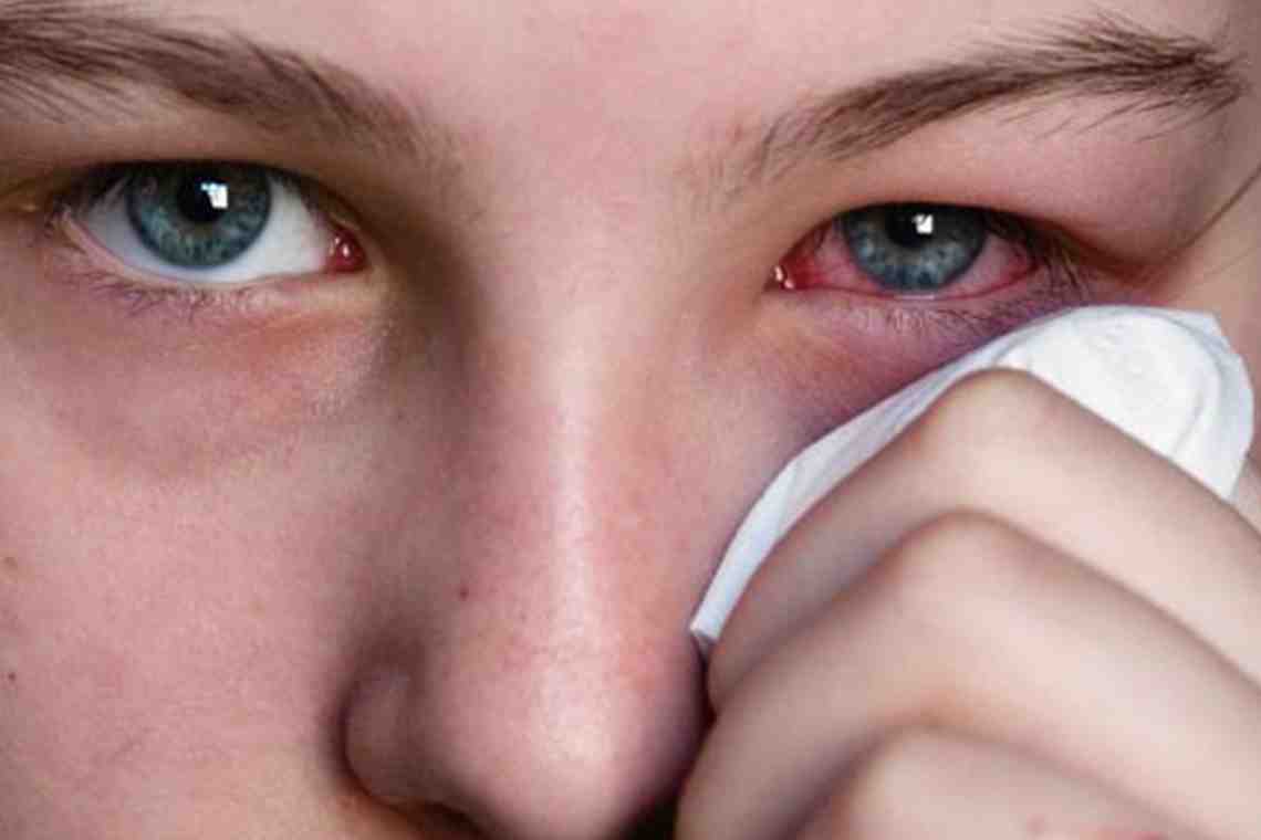 Аллергический конъюнктивит: симптомы, причины и особенности лечения