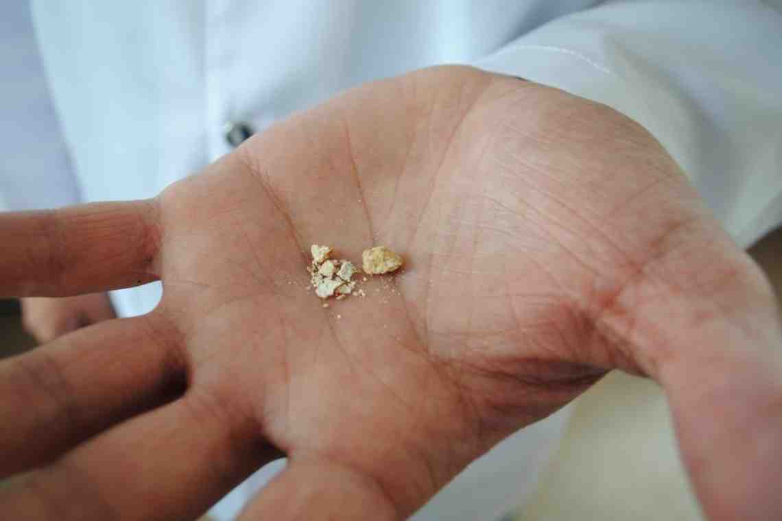 Уратные камни в почках: причины появления, лечение и профилактика
