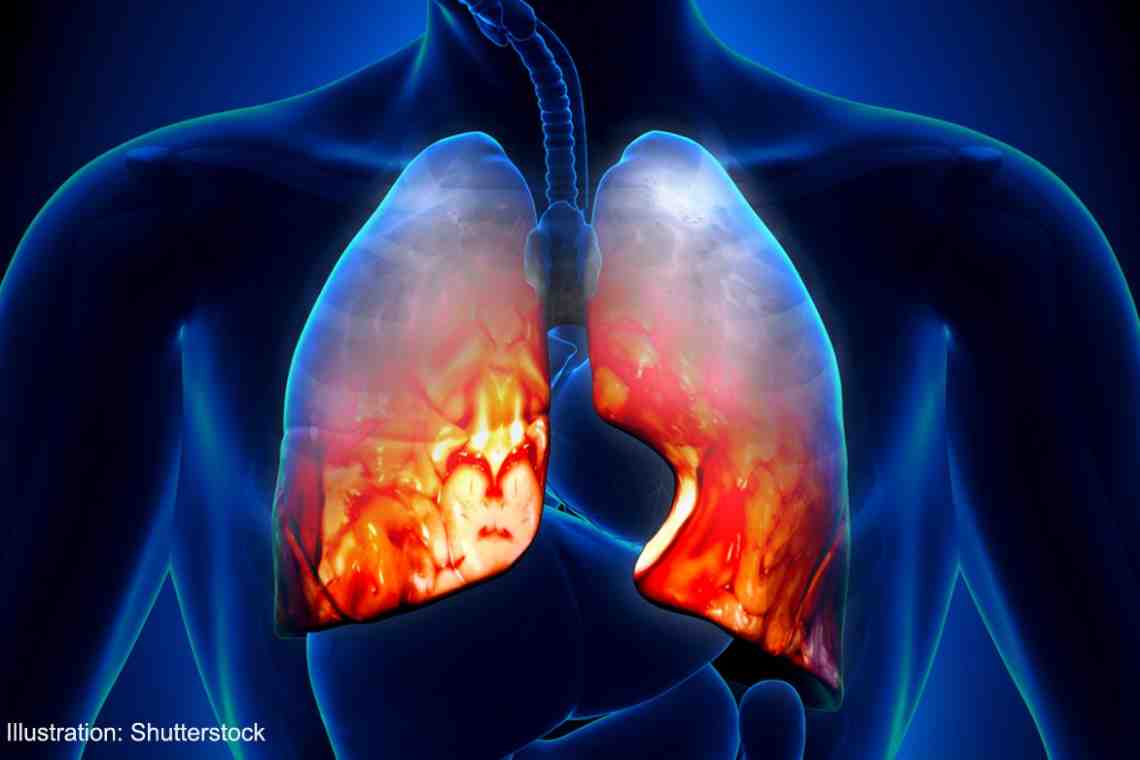 Двухсторонняя пневмония: как она проявляется, где и как ее лечить