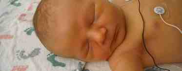 Болезнь гиалиновых мембран у новорожденных: причины, симптомы, лечение, последствия