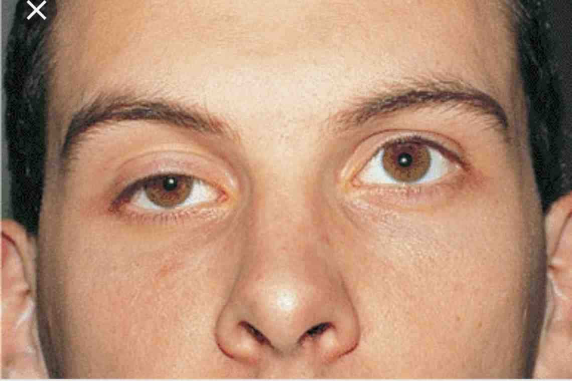 Поражение глазодвигательного нерва: симптомы