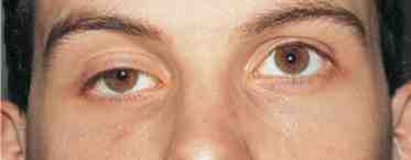 Поражение глазодвигательного нерва: симптомы